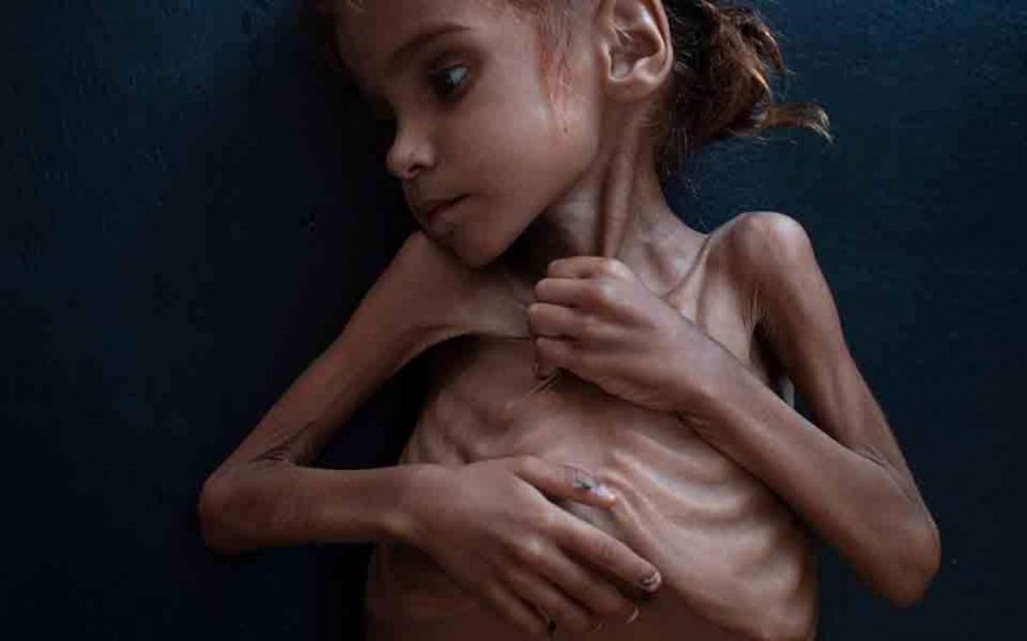 Απεβίωσε η 7χρονη Αμαλ, σύμβολο του λιμού στην Υεμένη