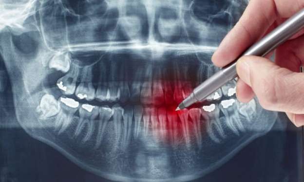 Μάχη κατά της τερηδόνας δίνουν Βρετανοί οδοντίατροι