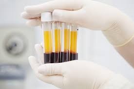 Covid-19: Απογοητευτικά τα αποτελέσματα μελέτης από τη θεραπεία με πλάσμα αίματος